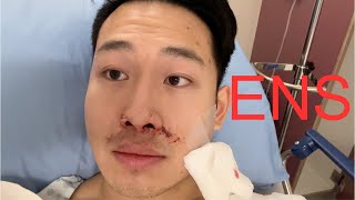 Deviated Septum Surgery  2 Week Review and Recovery  Septoplasty and Turbinate Reduction [upl. by Enttirb]