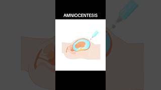 AMNIOCENTESIS amniocentesis  WHAT IS AMNIOCENTESIS shortsviraltrending [upl. by Ludwigg]