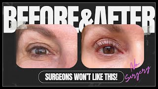 SKIP the surgery This eyelid treatment WORKS TIXEL eyelid LIFT [upl. by Ecirtram]