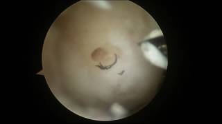 Arthroscopic Microfracture of the Knee with PowerPick [upl. by Etnuhs]