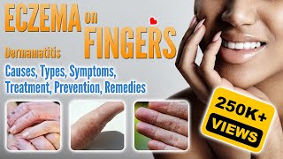 Eczema on Fingers Causes Types Symptoms Treatment and Remedies  Small Blisters and How To Treat [upl. by Ahtanamas774]