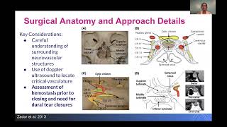 Pituitary Adenomas Diagnosis and Management by Sheena Kalagara [upl. by Keefer]