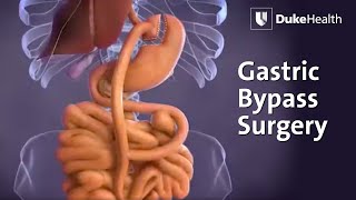 Gastric Bypass Surgery  Duke Health [upl. by Adam988]