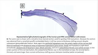 Corneal Ectasia Basics – A Deep Dive [upl. by Bevers]