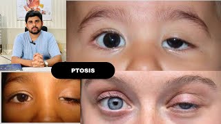 Ptosis and its classification drhashimjabbar education optometry eye ptosis [upl. by Langston]