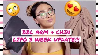 BBL ARM and CHIN LIPO 3 WEEK UPDATE VLOG [upl. by Annawat]