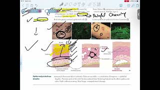 PEMPHIGUS VULGARISBULLOUS PEMPHIGOID [upl. by Denison453]