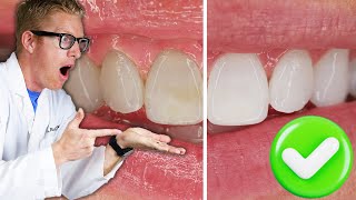 Dentist Reveals The BEST Teeth Whitening Results with Research Overnight Carbamide Peroxide Gel Kit [upl. by Liban88]