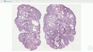 Juvenile polyp  Colon Histopathology [upl. by Ajay]