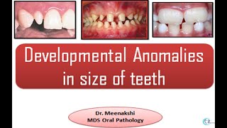 Developmental disturbances in Size of teeth [upl. by Recnal2]