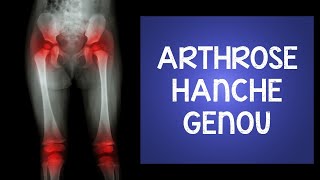 Arthrose au genou et à la hanche  des exercices étonnants [upl. by Nivk585]