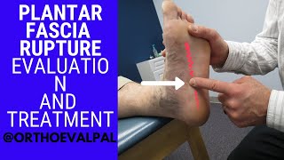 Plantar Fascia Rupture Evaluation with Paul Marquis PT [upl. by Doroteya632]