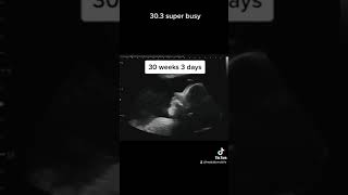 2D Ultrasound at 30 Weeks 3 Days Busy Baby [upl. by Anaj]