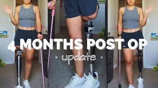 I AM FINALLY SEEING THE FINISH LINE  my osseointegration vlog pt 5 [upl. by Ettenwahs]