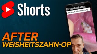 Speisereste nach Zahnextraktion shorts [upl. by Ettena]