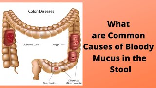 What are Common Causes of Bloody Mucus in the Stool [upl. by Nealah832]