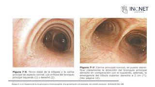 Broncoscopía [upl. by Bosch937]