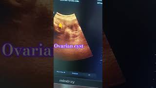 Lower abdomen scan Right ovarian cyst ultrasound usg ovary cystic [upl. by Solenne795]