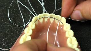 Bonded Retainer following orthodontics treatment [upl. by Ewall]