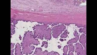 Histopathology OvaryBorderline ovarian tumor [upl. by Mulcahy]