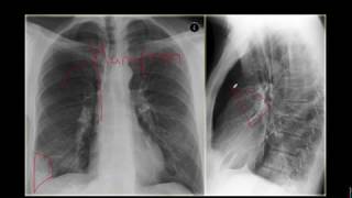 Tromboembolismo Pulmonar [upl. by Aninay]