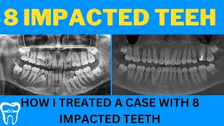 bracesorthodontic treatment for 8 impacted teeth in a single patientcaninepremolarBEFORE amp AFTER [upl. by Burdett]