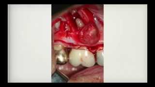 Actinomycosis of the Jaw Nasseh Case report amp Interview with Dr Eleni Gagari [upl. by Abbott]