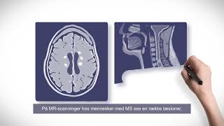 Har jeg multipel sclerose MS [upl. by Olemrac262]