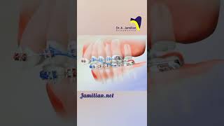 Upper Jaw Retraction Using First Molar Extraction bracs dentist orthodontics smile extraction [upl. by Rafaelof]