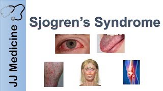 Sjogren’s Syndrome quotDry Eye Syndromequot  Primary vs Secondary Symptoms Diagnosis and Treatment [upl. by Cristabel]