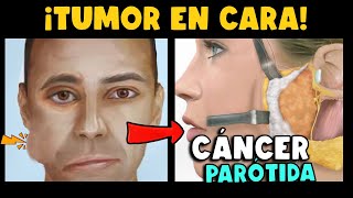 ¡CUIDADO ¿TUMOR EN CARA ¿ASIMETRÍA FACIAL ¿QUÉ ES EL CÁNCER DE PARÓTIDA [upl. by Voe]