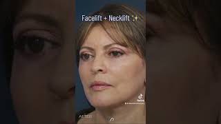 Amazing Transformation See My Face and Neck Lift Before and After Results [upl. by Nosaes945]