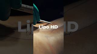 Lipo HD na paciente de 47 anos [upl. by Lleinad]