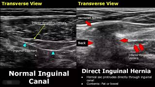 Hernia Ultrasound Normal Vs Abnormal Images  DirectIndirect InguinalEpigastricFemoral Hernia USG [upl. by Sura]