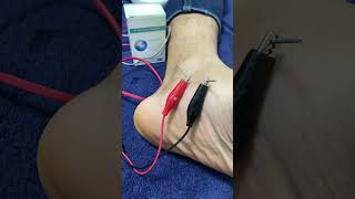 Dry needling  Tendinite de jambier posterieur douleur au pied [upl. by Hurley24]