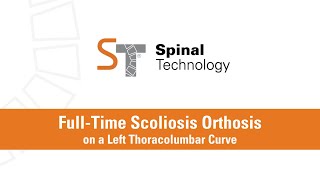 FullTime Scoliosis Orthosis on a Thoracolumbar Curve [upl. by Stefanac766]