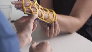 Un plâtre futuriste en 3D pour soigner les fractures plus rapidement [upl. by Anselma]