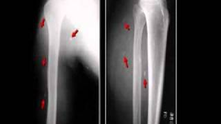 LearningRadiology 27 Soft Tissue Calcifications II [upl. by Alikam]