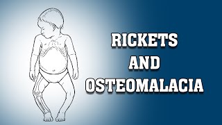 RICKETS AND OSTEOMALACIA [upl. by Damales]