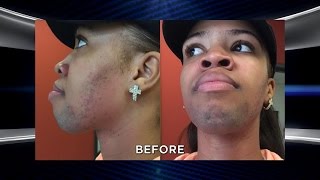 Woman Plagued by Excessive Facial Hair Returns with an Amazing Transformation [upl. by Kazmirci154]