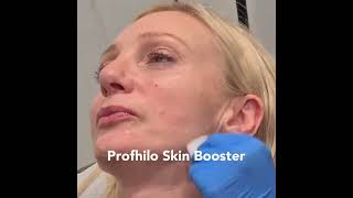 Profhilo injectable moisturiser demo at City Skin Clinic shortsvideo beauty skincare profhilo [upl. by Groscr]