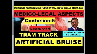 CONTUSION5 OR BRUISE MEDICOLEGAL ASPECTS ARTIFICIAL BRUISE KIND OF WEAPON bruise contusion [upl. by Dlorad]