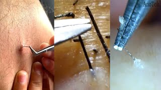 Ingrown Hair Removal  Satisfying Ingrown Hair 6 [upl. by Nilatak]