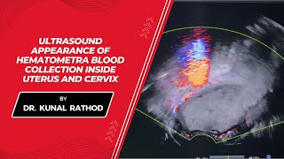 Ultrasound appearance of hematometra blood collection inside uterus and cervix  Dr Kunal Rathod [upl. by Aeriela]