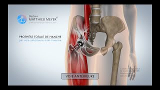 PROTHÈSE TOTALE DE HANCHE PAR VOIE ANTÉRIEURE MINIINVASIVE  DR MATTHIEU MEYER [upl. by Tterrej632]