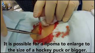 Office Procedure Lipoma Removal [upl. by Allsun]