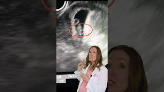 Can you HEAR the Heartbeat on a 7 Week Ultrasound [upl. by Ellene]