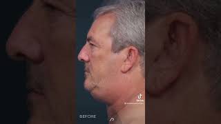 Watch the Incredible Results Neck Lift amp Liposuction Transformation [upl. by Kurt]