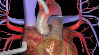 Coronaire bypass CABG [upl. by Arayc]