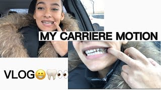 MY CARRIERE MOTION APPLIANCE  VLOG [upl. by Enneira]